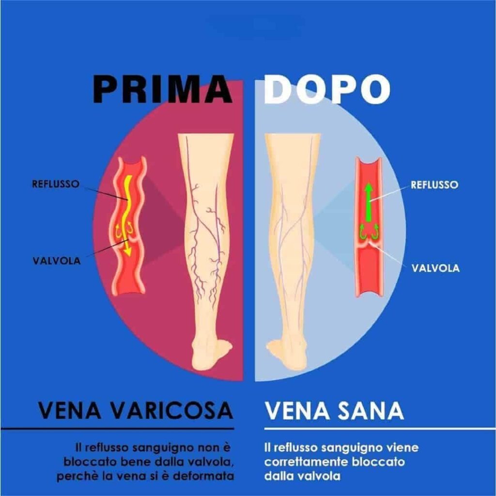 CREMA-VENE-VARICOSE-E-CAPILLARI-1-min.jpg